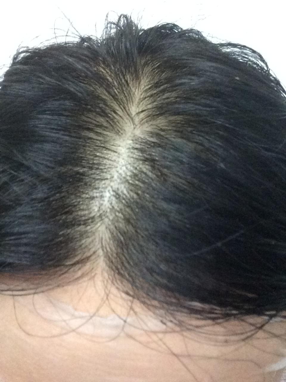 女生22,三年前发现头发越来越少,头发细软少,医院医生说是脂溢性脱发