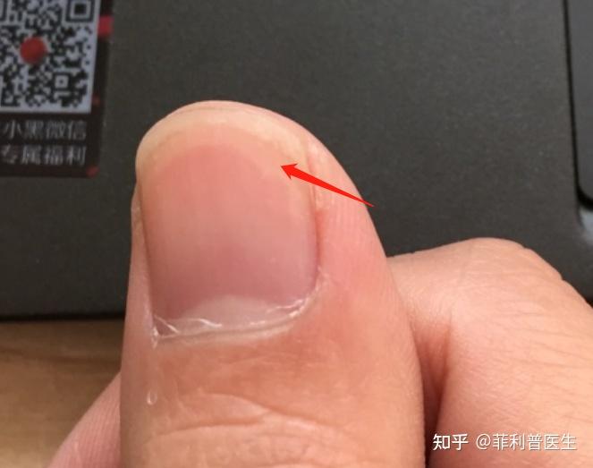 指甲前端有白色圆弧线每个指甲都有是什么原因
