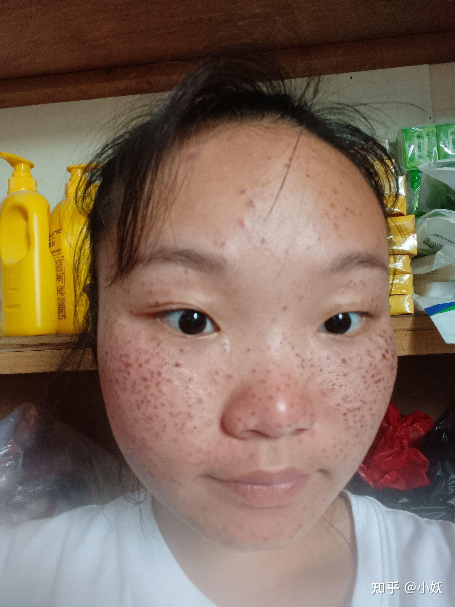 用药水去雀斑可靠吗?