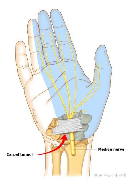 腕管綜合徵和手部腱鞘炎的區別是什麼保持一個姿勢手掌痛手指麻木是哪