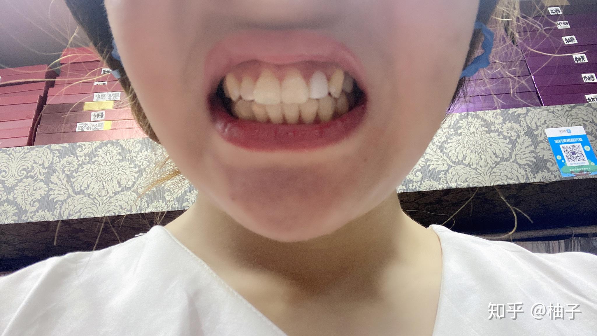 本人去做了超薄牙齿贴面牙齿表面被磨掉一层很后悔得知贴面有许多后遗