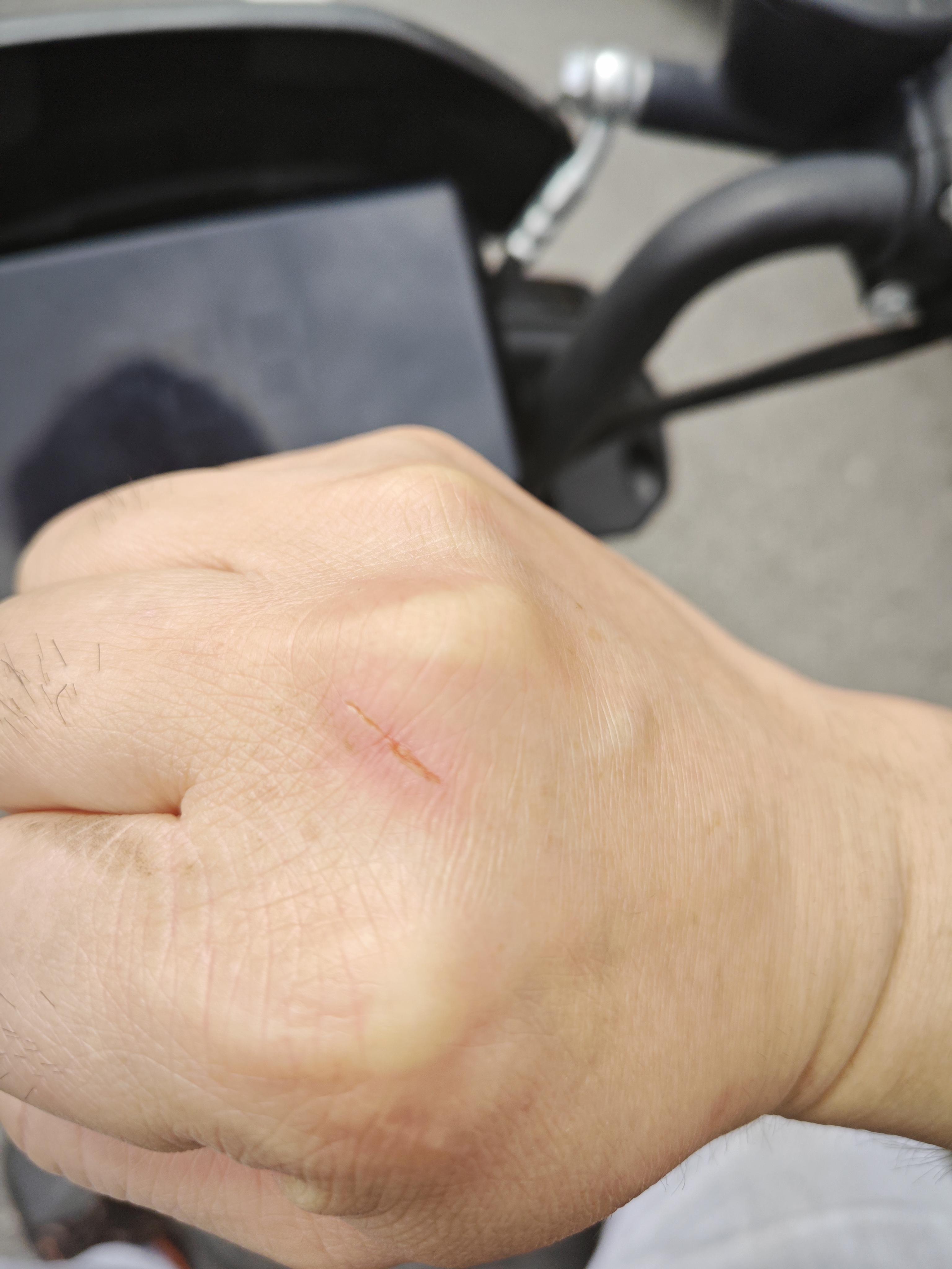 员工划破手指类的小伤,简单包扎即可的轻伤,大家也报工伤吗?