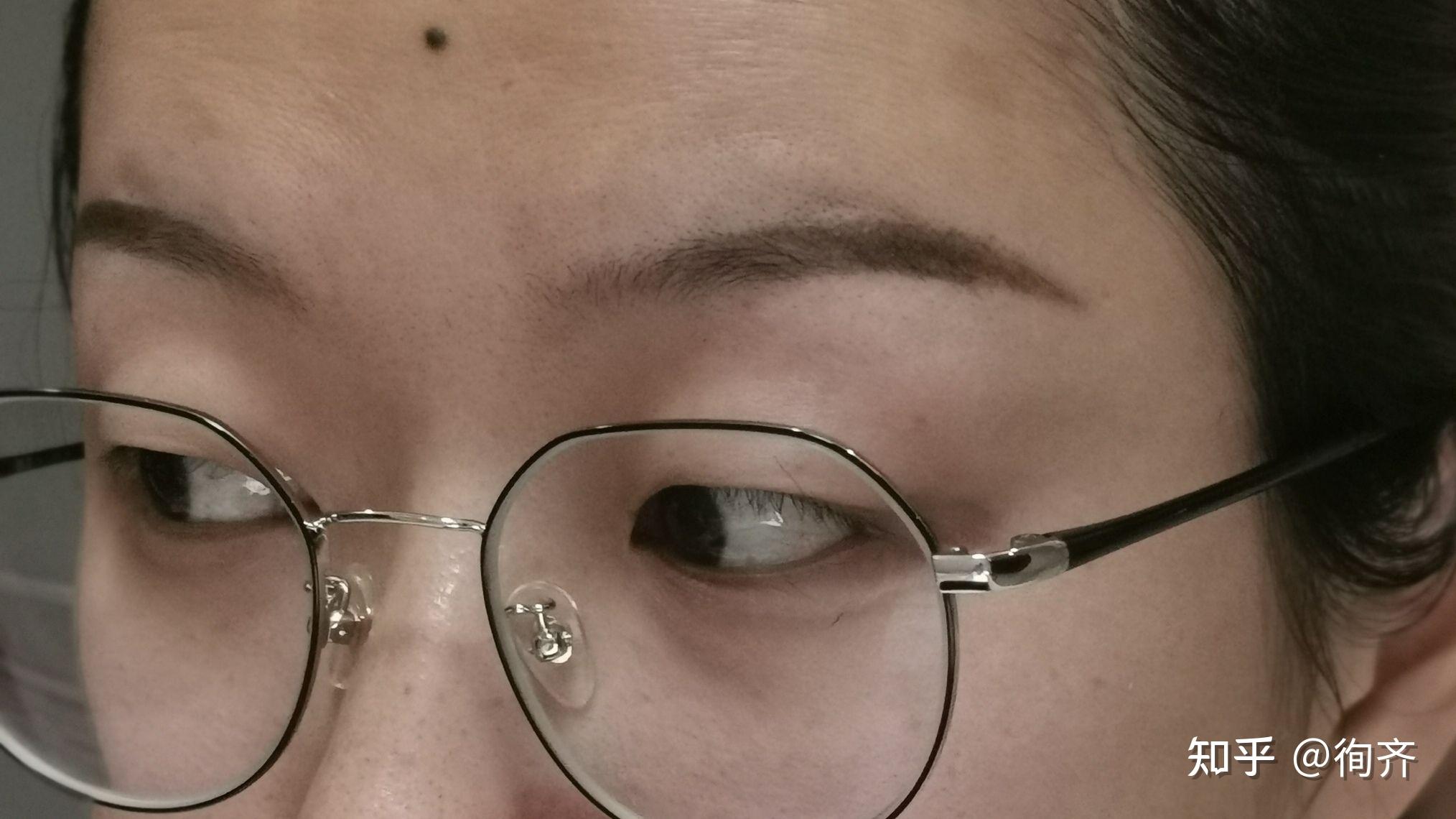 得了甲亢一个眼睛突出突,能回去吗? - 知乎