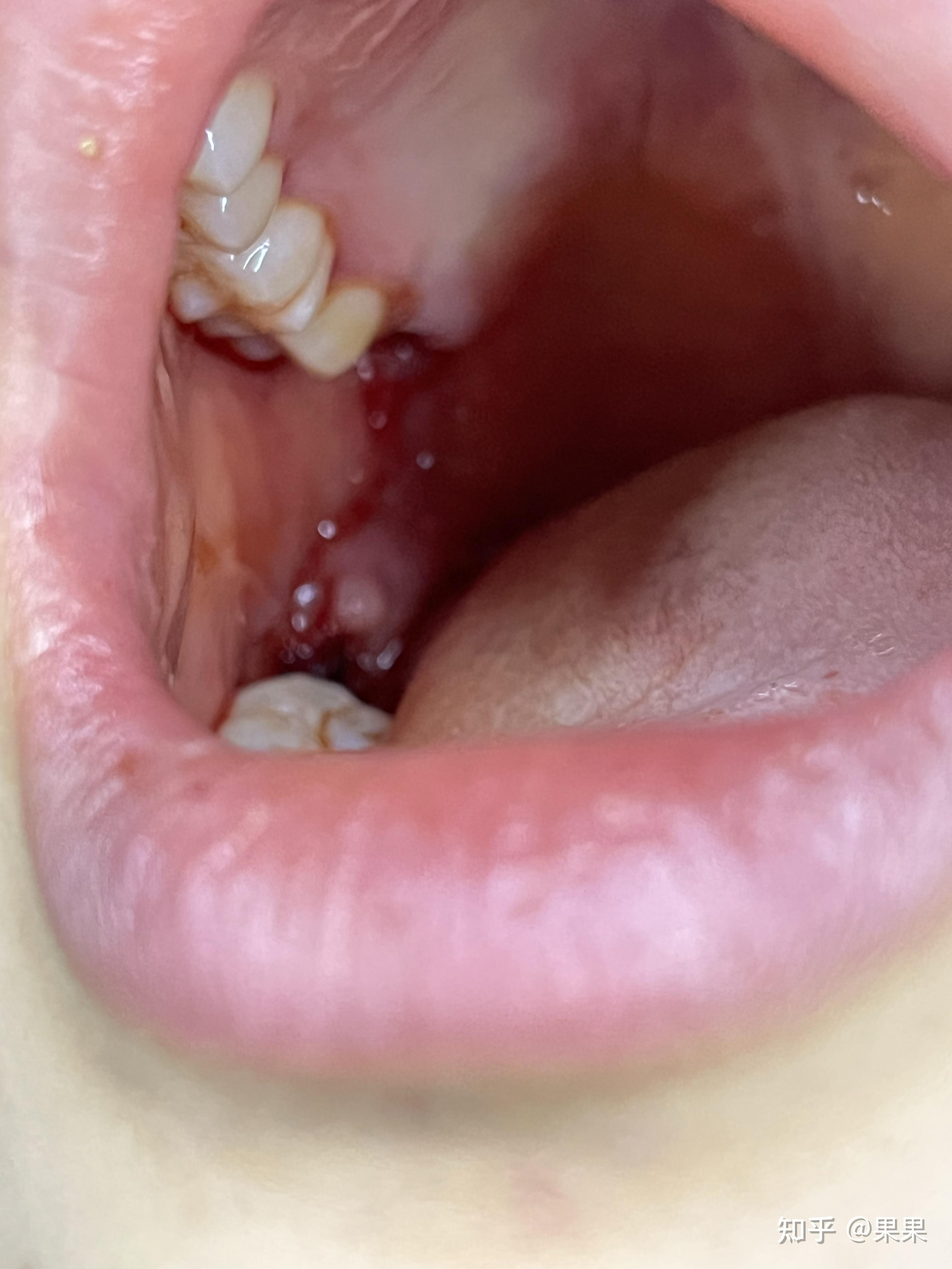 成都高德口腔拔智齿怎么样