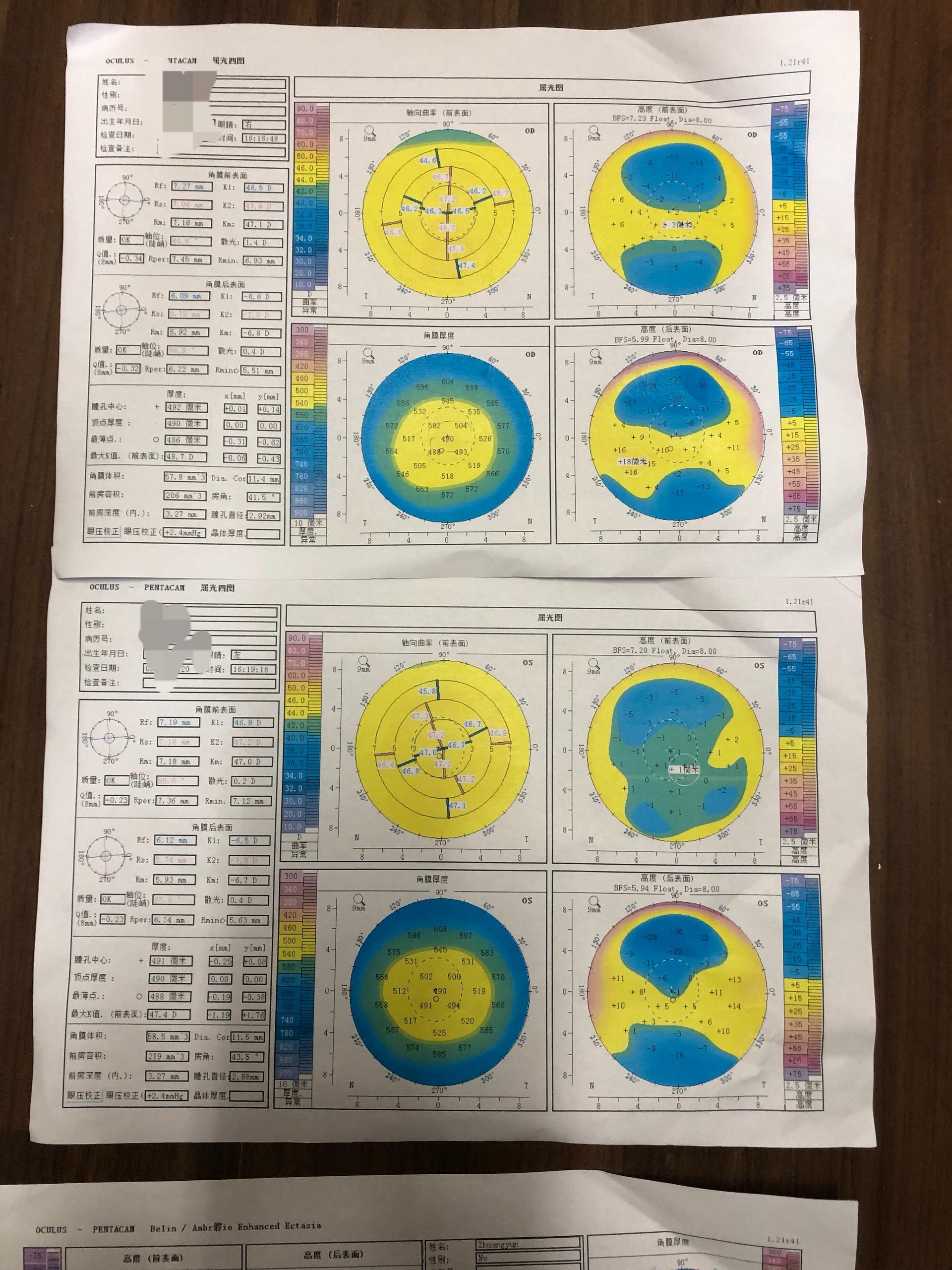 角膜地形图是圆锥角膜吗? - 知乎