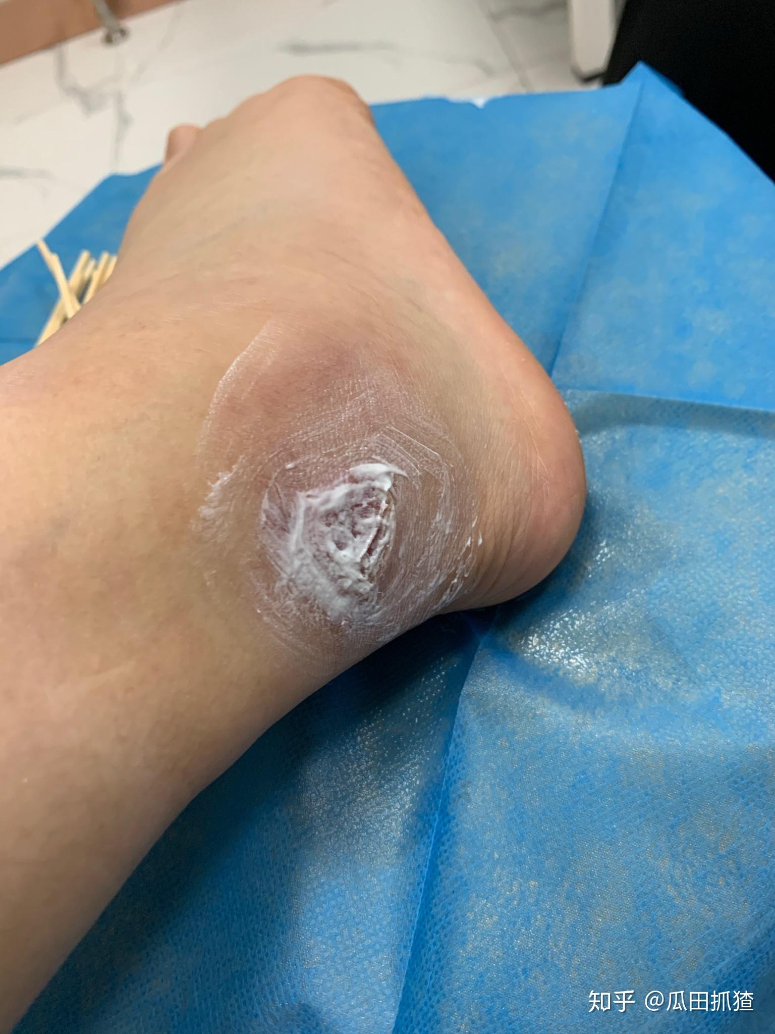 被隐翅虫咬了会怎么样