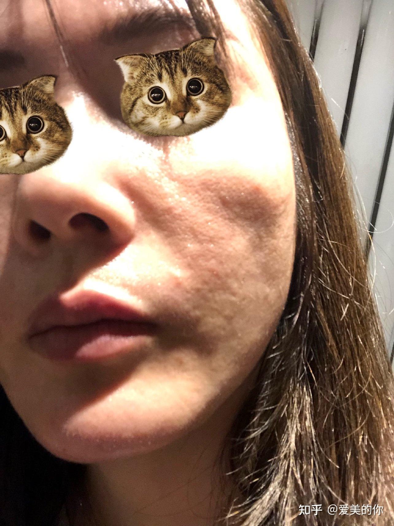 面部吸脂会凹凸不平吗