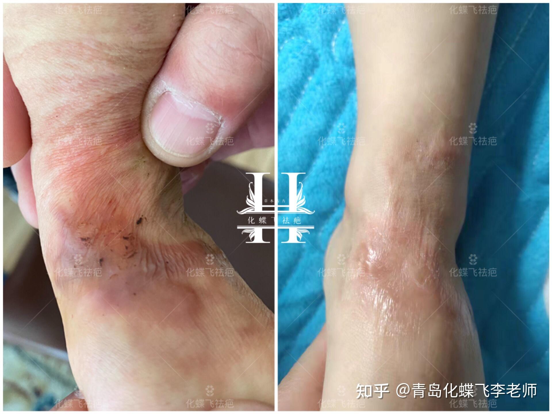 一岁多宝宝烫伤疤痕修复 - 知乎
