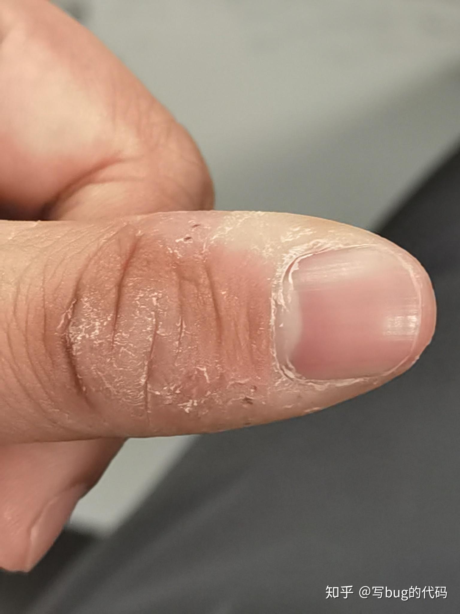 咬手皮是一种怎样的心理? - 知乎