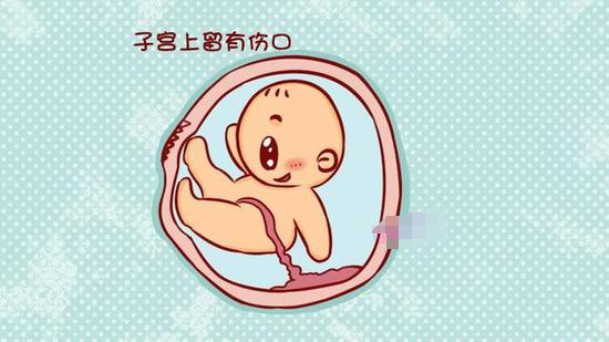 10年连生4胎,胎胎都是剖腹产,医生:真的不要再赌命生孩子了! - 知乎