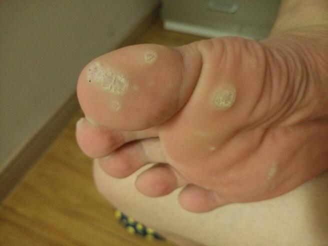 脚上这样茧子怎么治啊