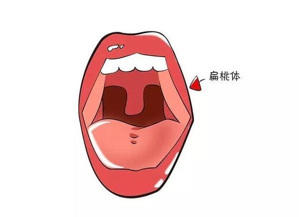 咽喉囊肿会有哪些症状表现 - 知乎