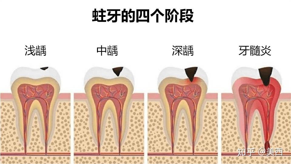 蛀牙产生的原因是什么如何预防和应对