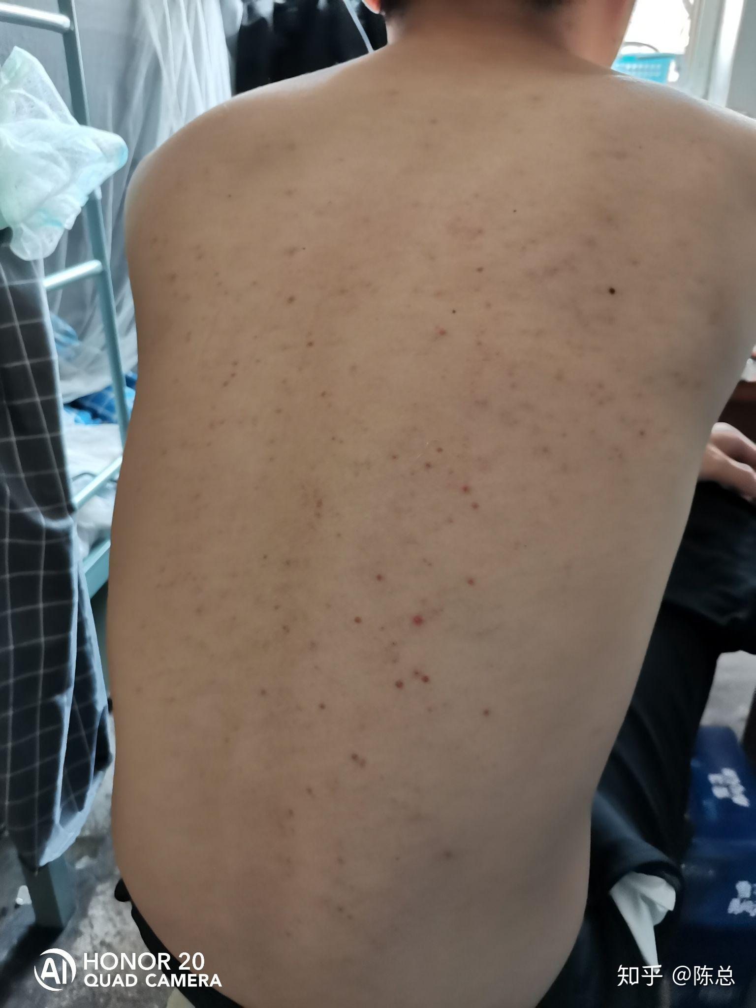 背部痘痘擦什么会比较好？ - 知乎