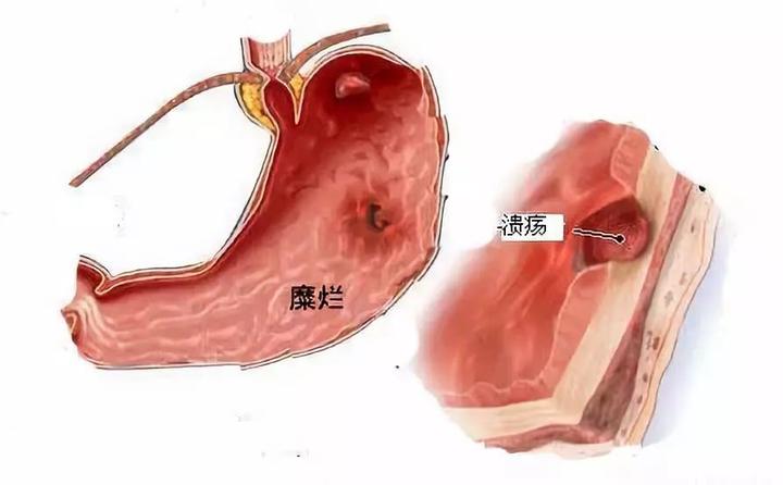 十二指肠溃疡和胃溃疡之间有区别