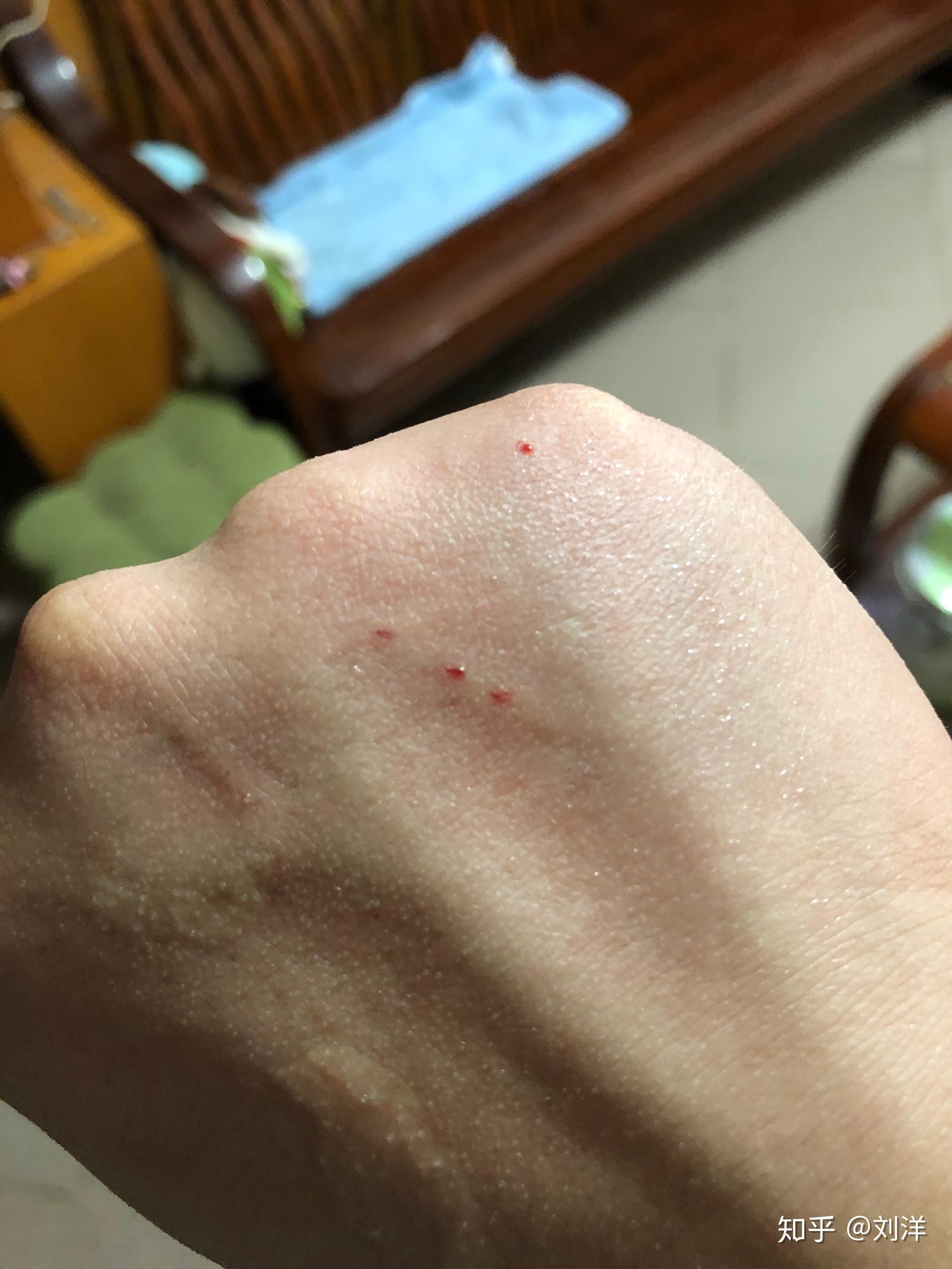 被猫抓伤出血了需要打疫苗吗? - 知乎