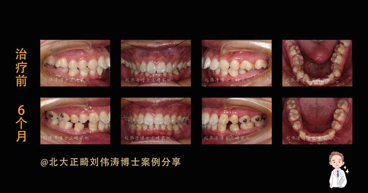 隐适美矫正案例|6个月解除后牙锁颌 - 知乎