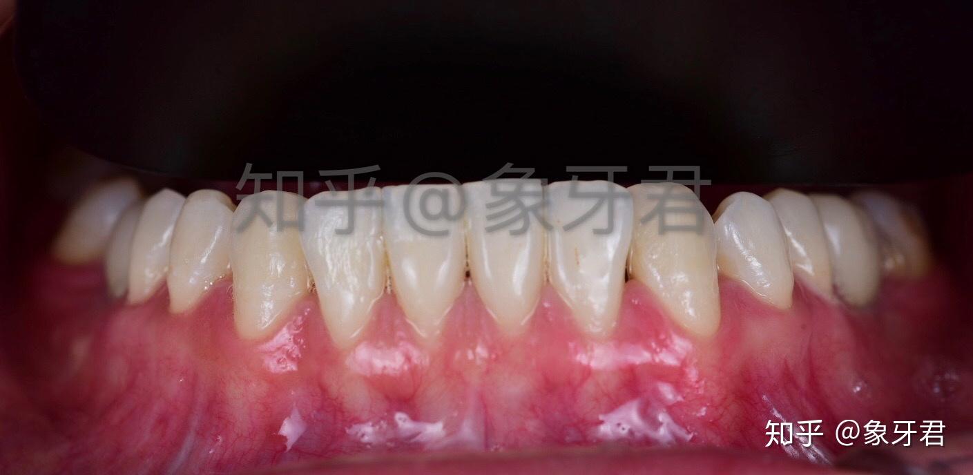 正畸后留下黑三角(牙龈萎缩)的你们还好吗? - 知乎