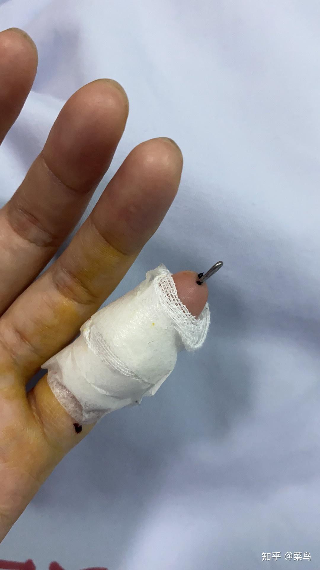 手指肌腱断裂有解无解