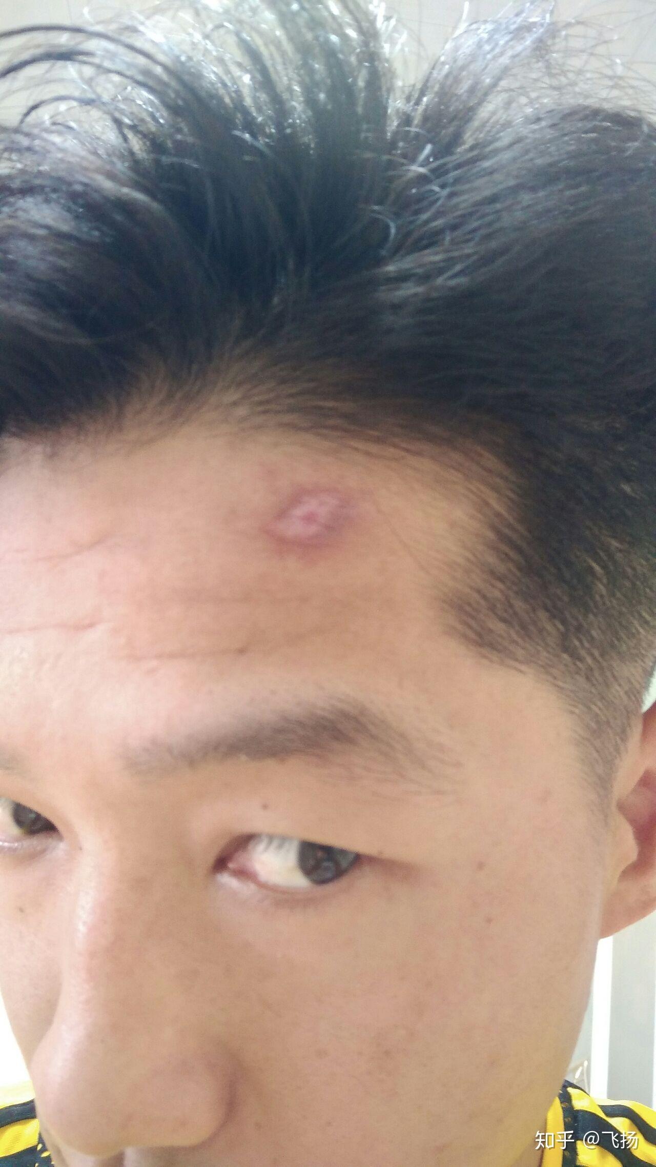 如何消除额头增生性疤痕? - 知乎