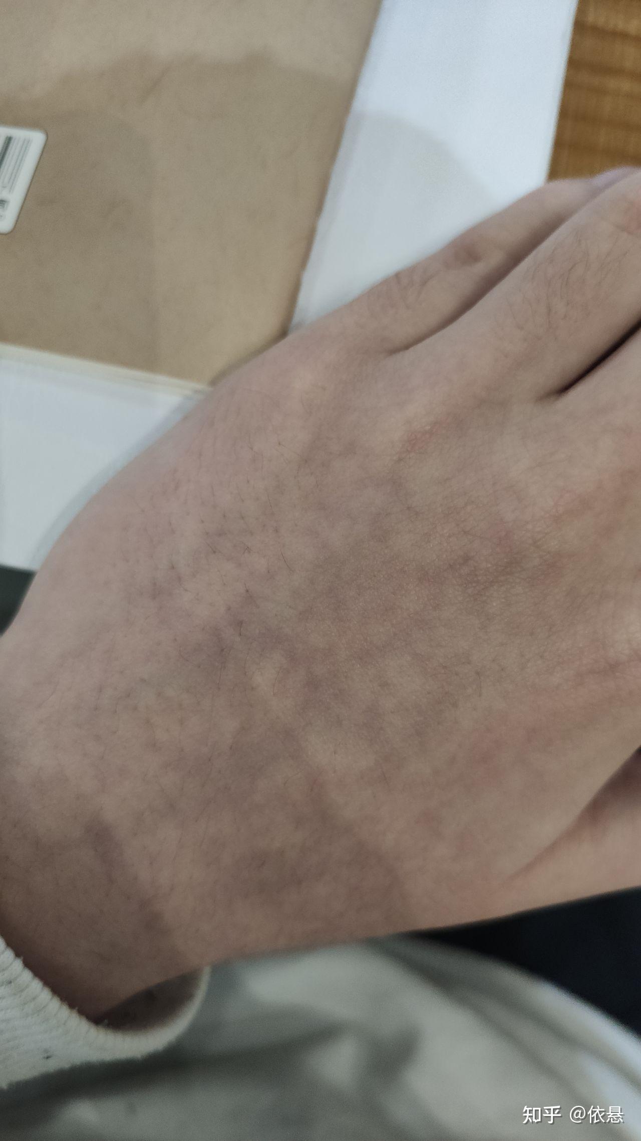 请问天冷时手心手背都发乌发紫是为什么是身体有什么问题吗