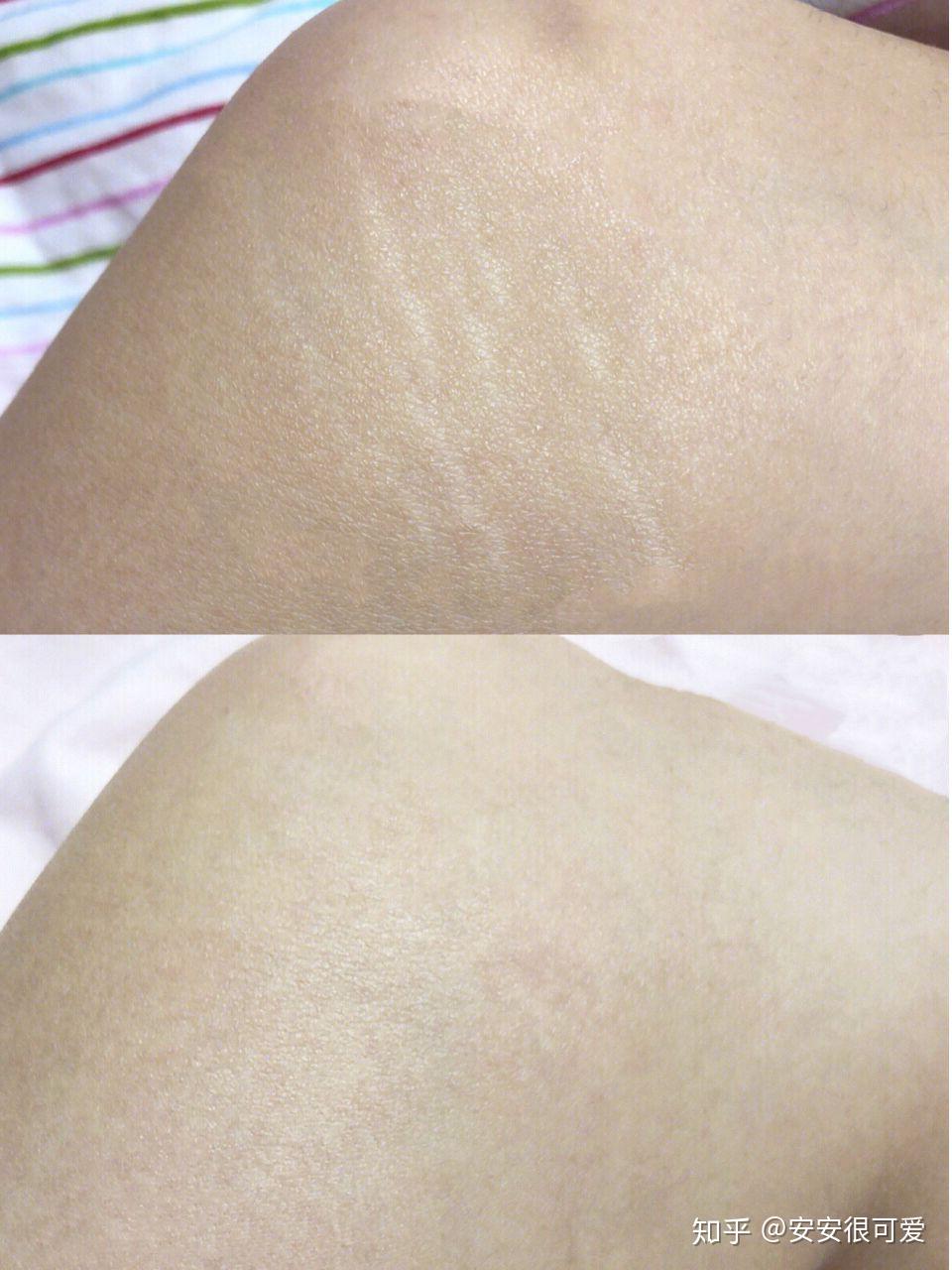 腿上的肥胖纹可以去掉么