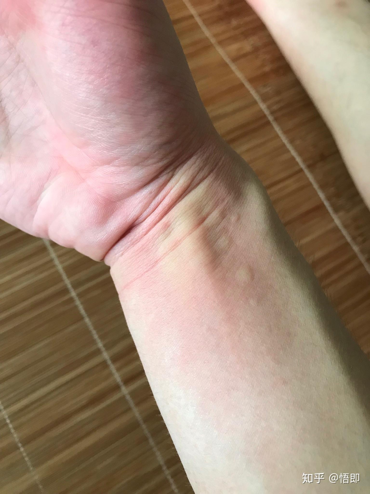 为什么会有紫外线过敏紫外线过敏如何治疗