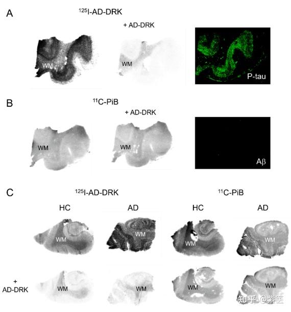 PET/CT 太贵？要不试试 SPECT/CT，还是Aβ与Tau双靶点探针！ - 知乎