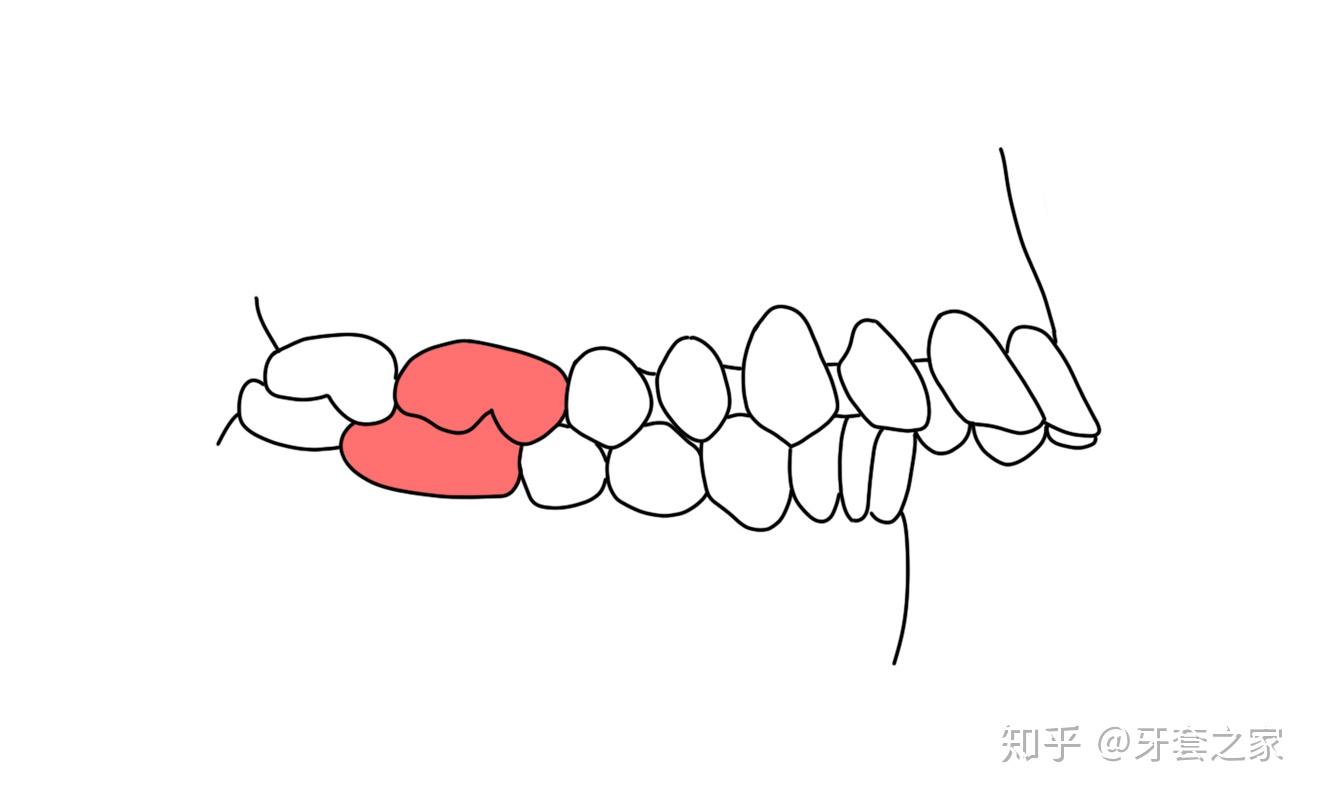 安氏分类ⅠⅡⅢ，你的牙齿是哪类 - 知乎