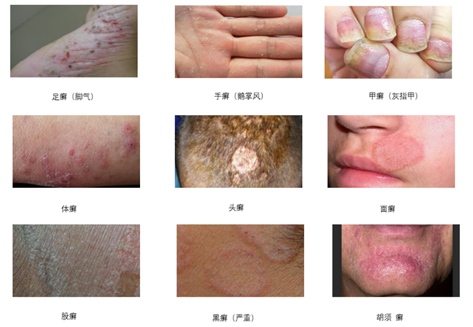 脚气篇足癣手癣甲癣有联系吗