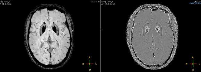 苍白球钙化的影像表现