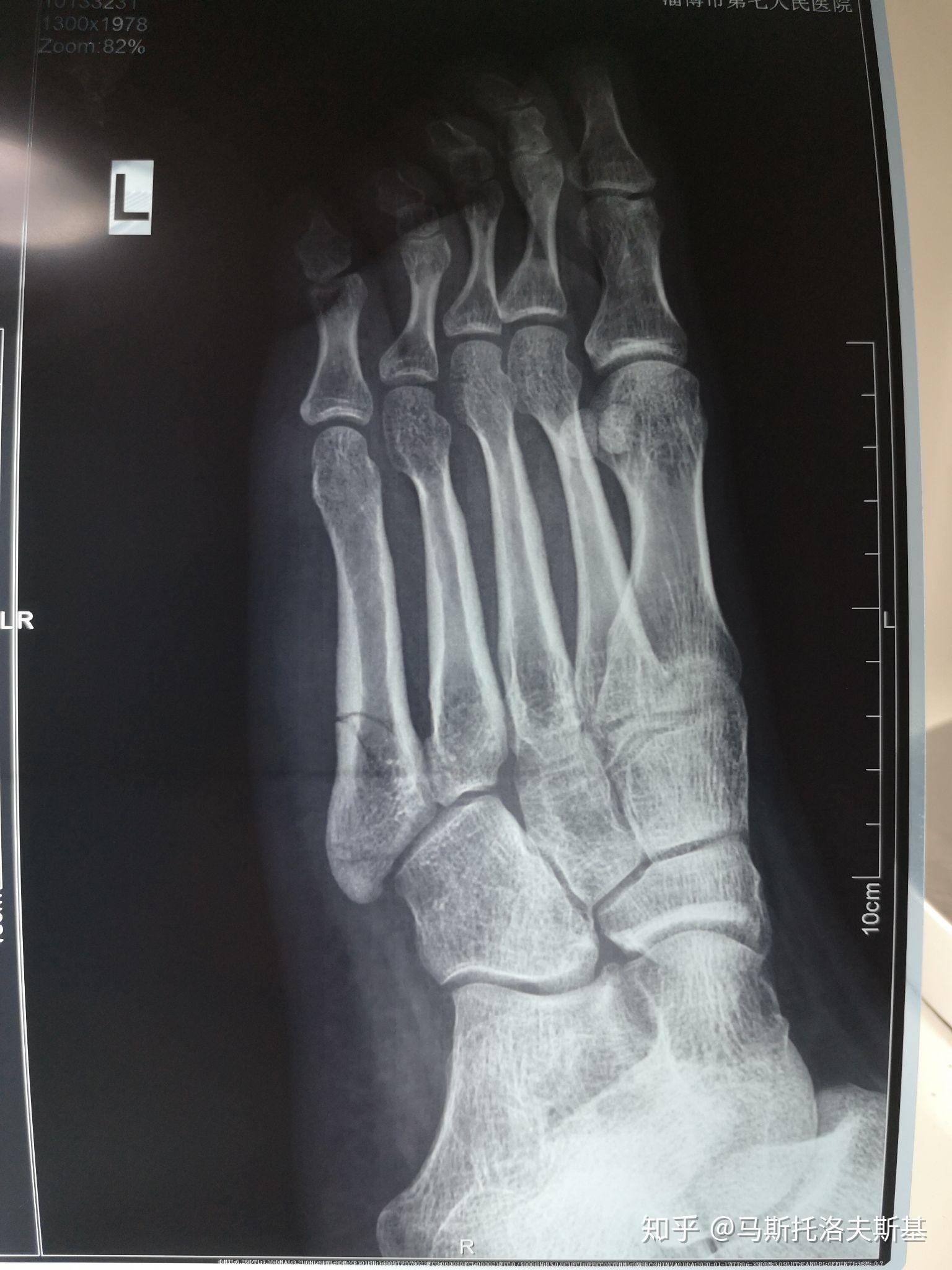 左脚第五跖骨骨折