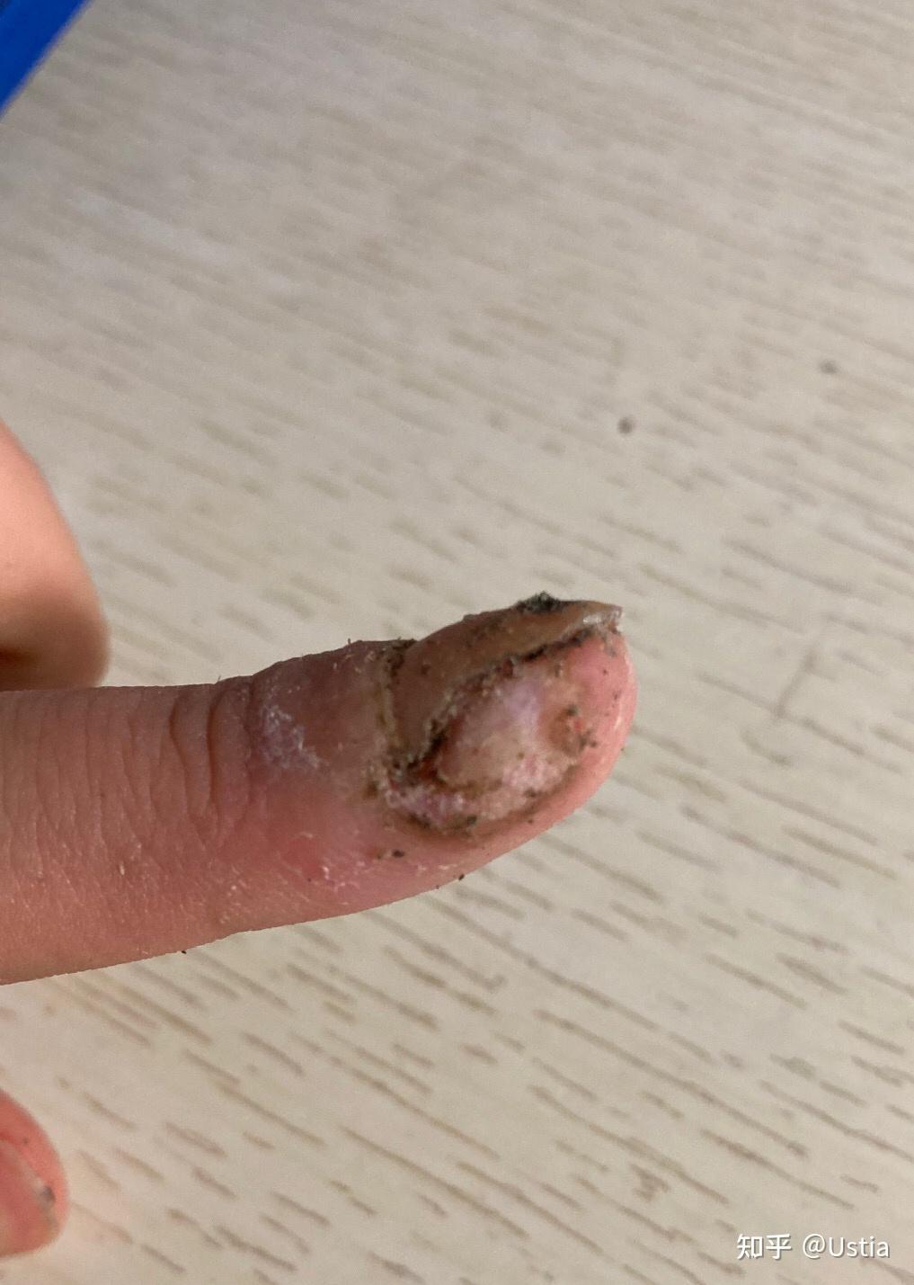 各位大神鄙人手残手指甲旁边长了死皮用指甲刀剪的时候把一些肉也剪了