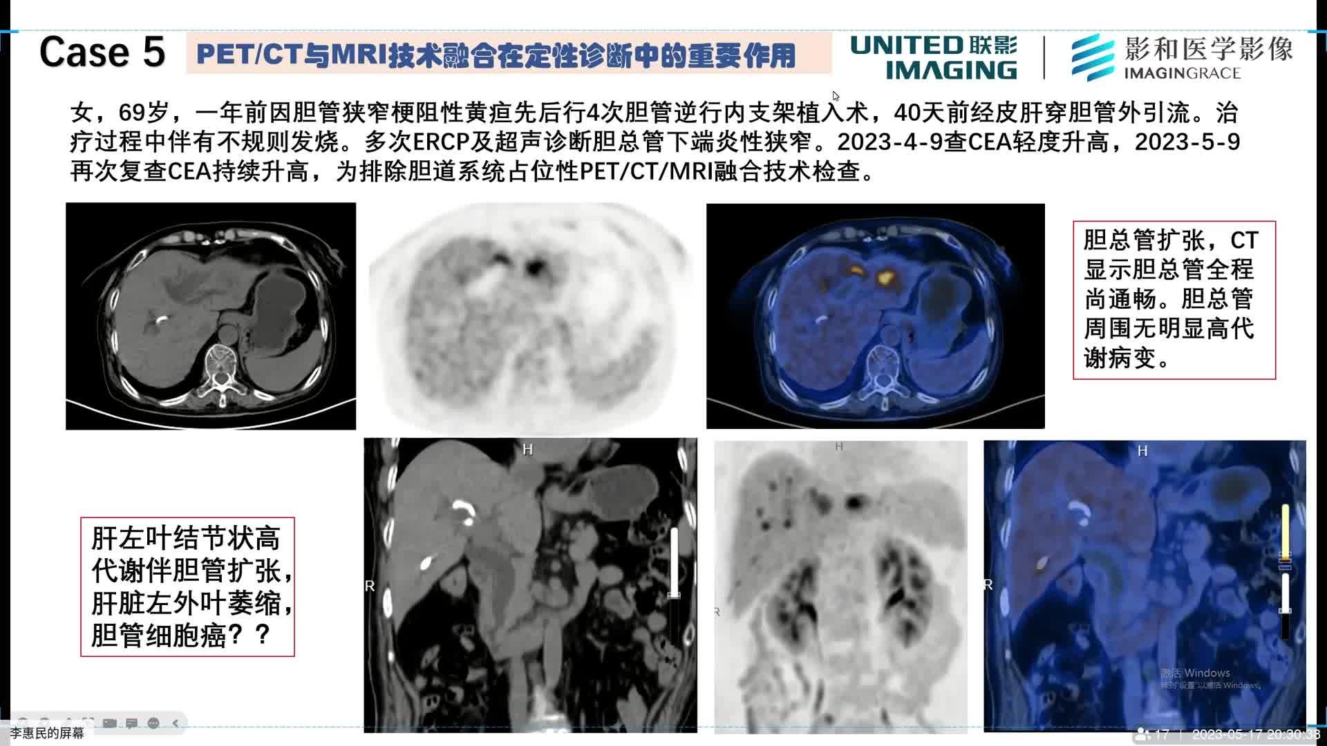 PET/CT+MRI多模态融合技术解决了患者长达13个月的痛苦 - 知乎