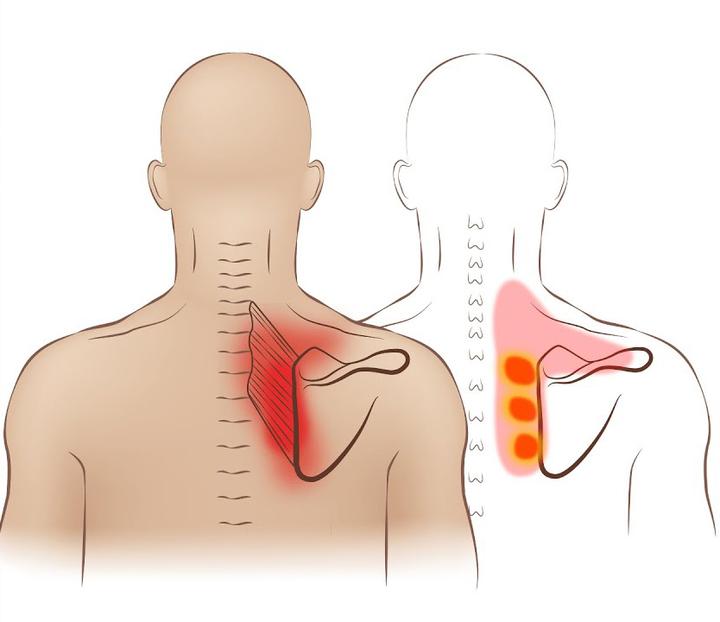 肩胛骨缝疼,劝你不要再乱按了!