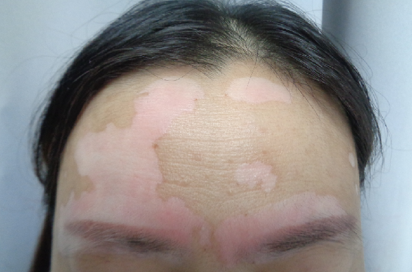 壮观的长白斑是缺少什么营养素的照片