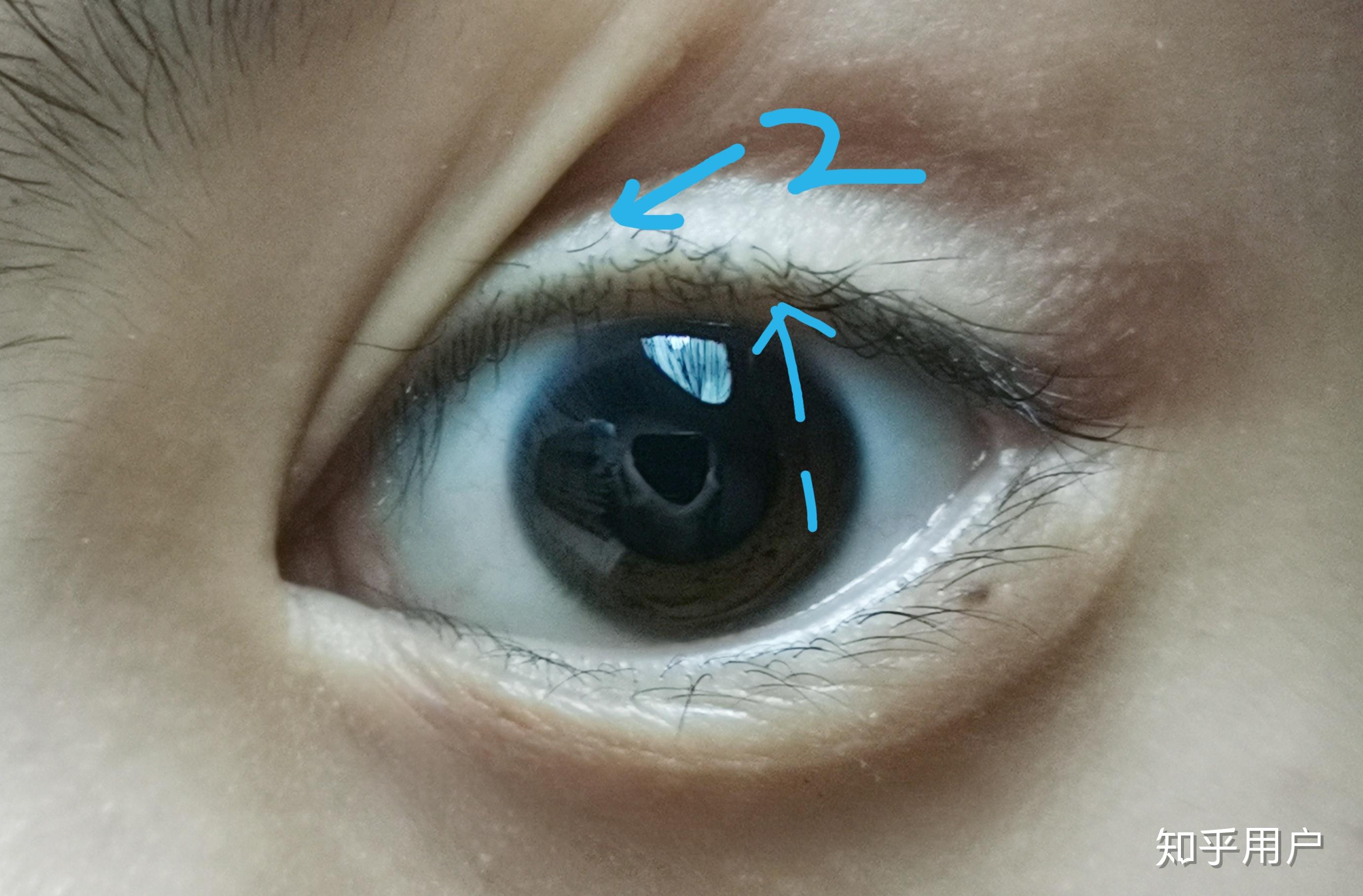 双睫症到底是啥