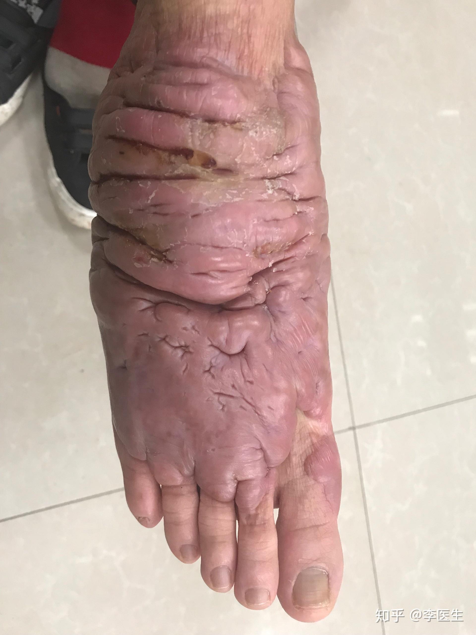 煤气爆炸全身45严重烧伤请问会对以后生活带来什么影响