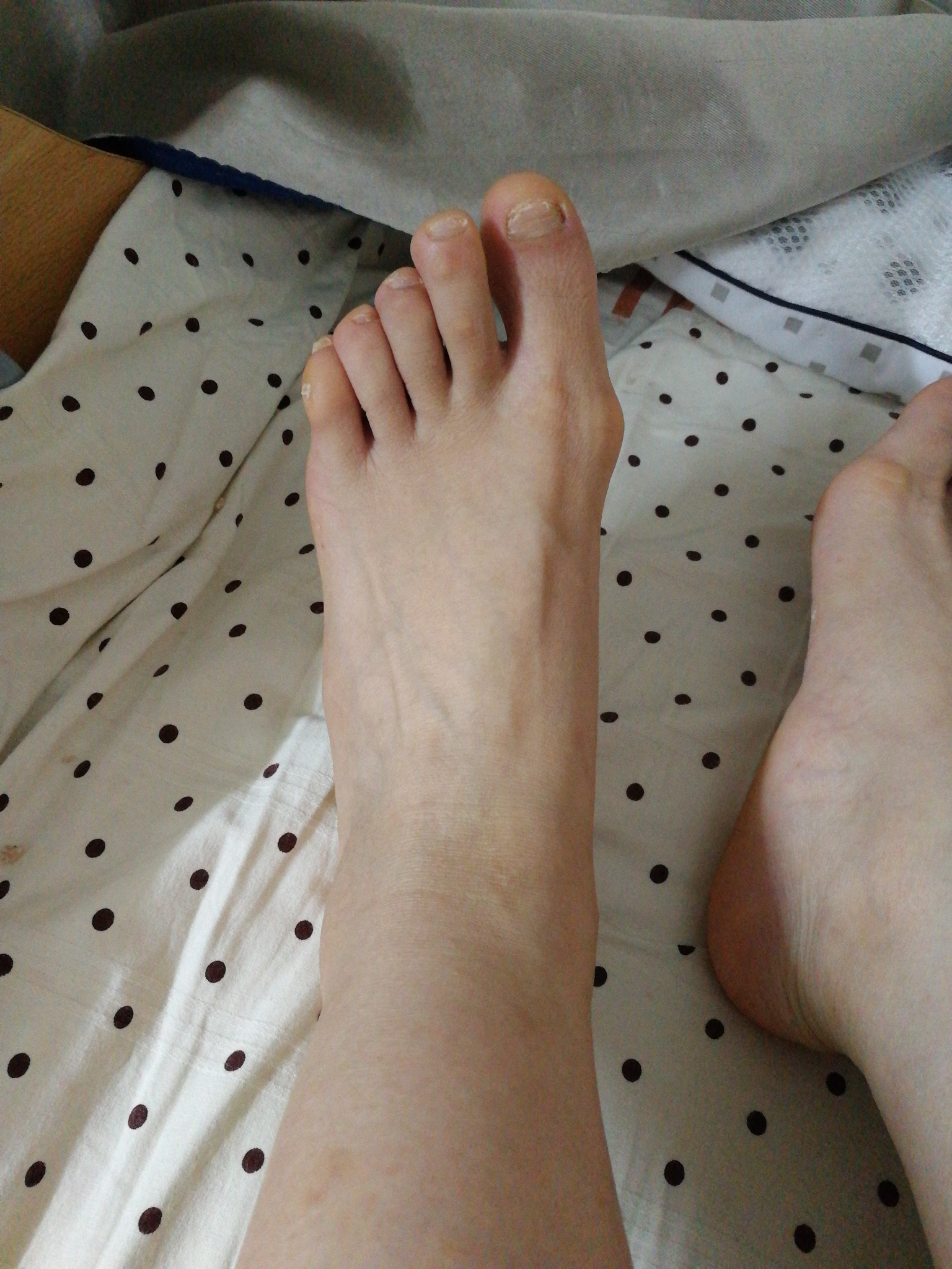 女生脚趾拇外翻是什么样体验