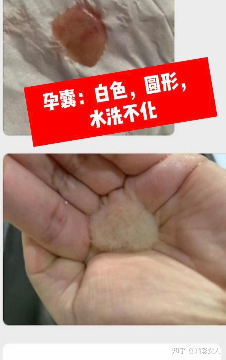 药流排出孕囊长什么样?