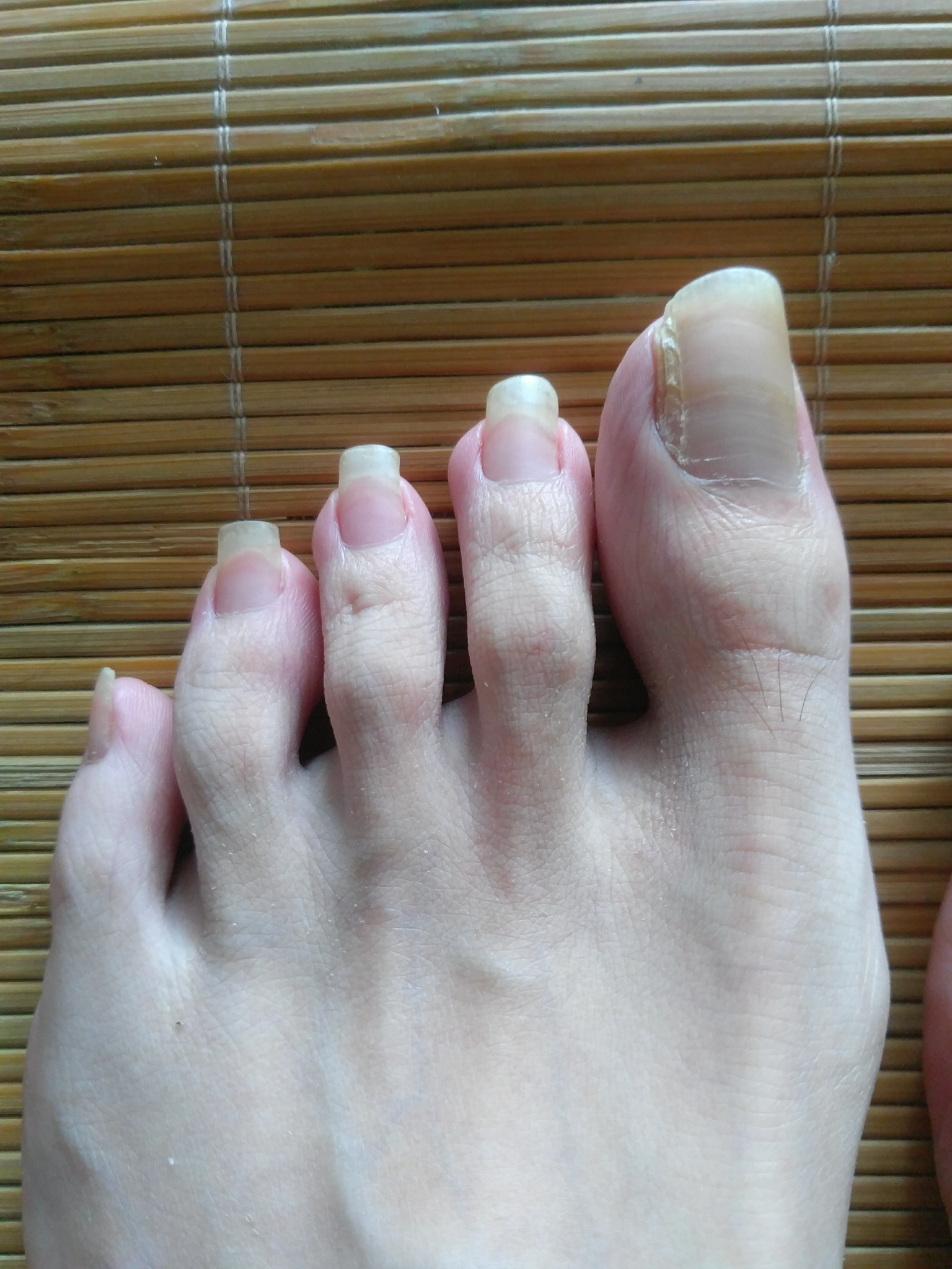 脚指甲长肉里了如何解决