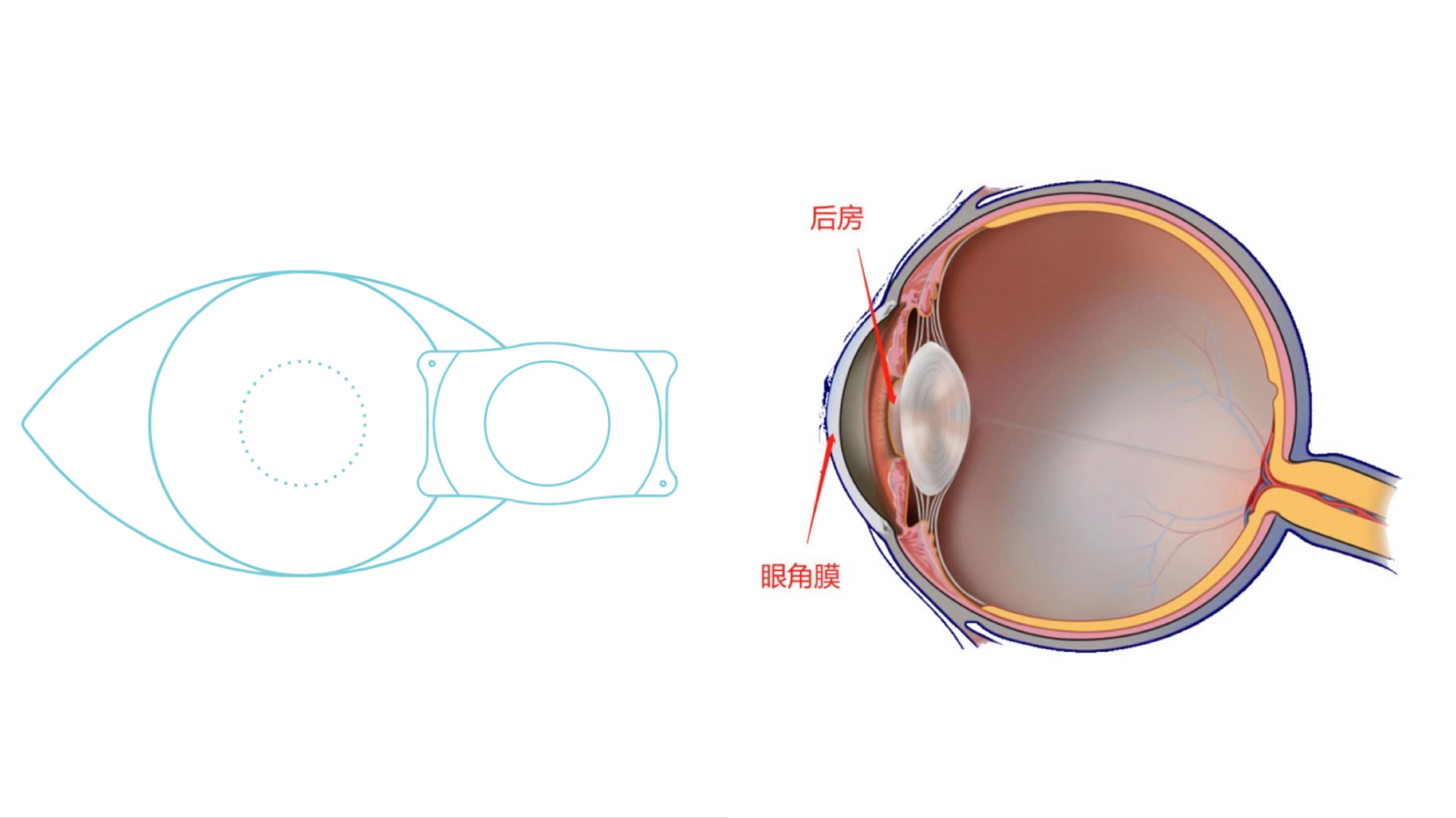 icl晶体植入手术适合什么条件的近视患者,植入后需要注意什么,植入后