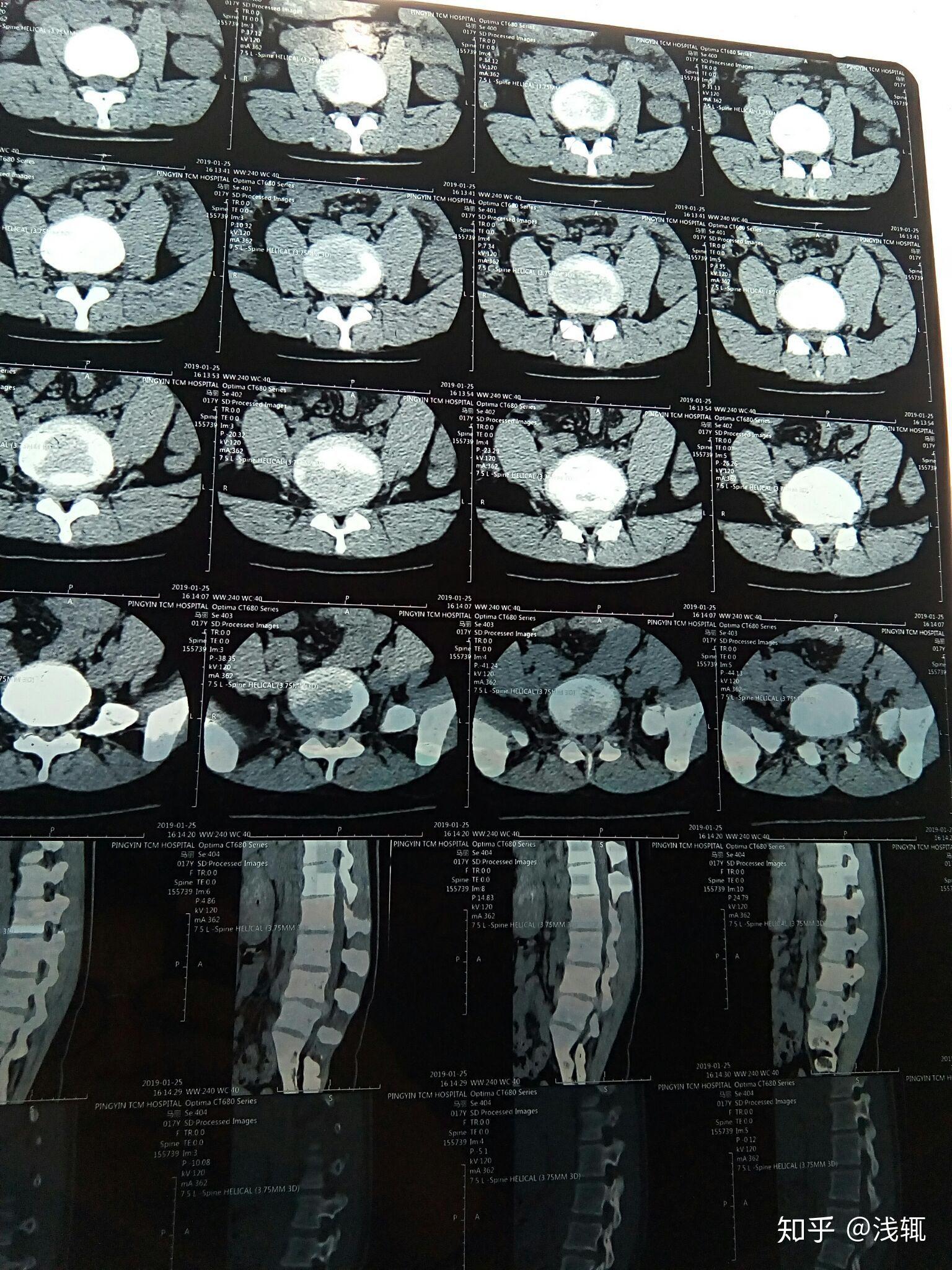 腰椎4一5节突出图片图片