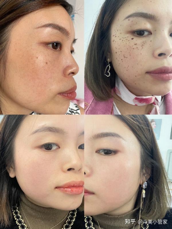 广州有哪些靠谱的祛斑医院吗?