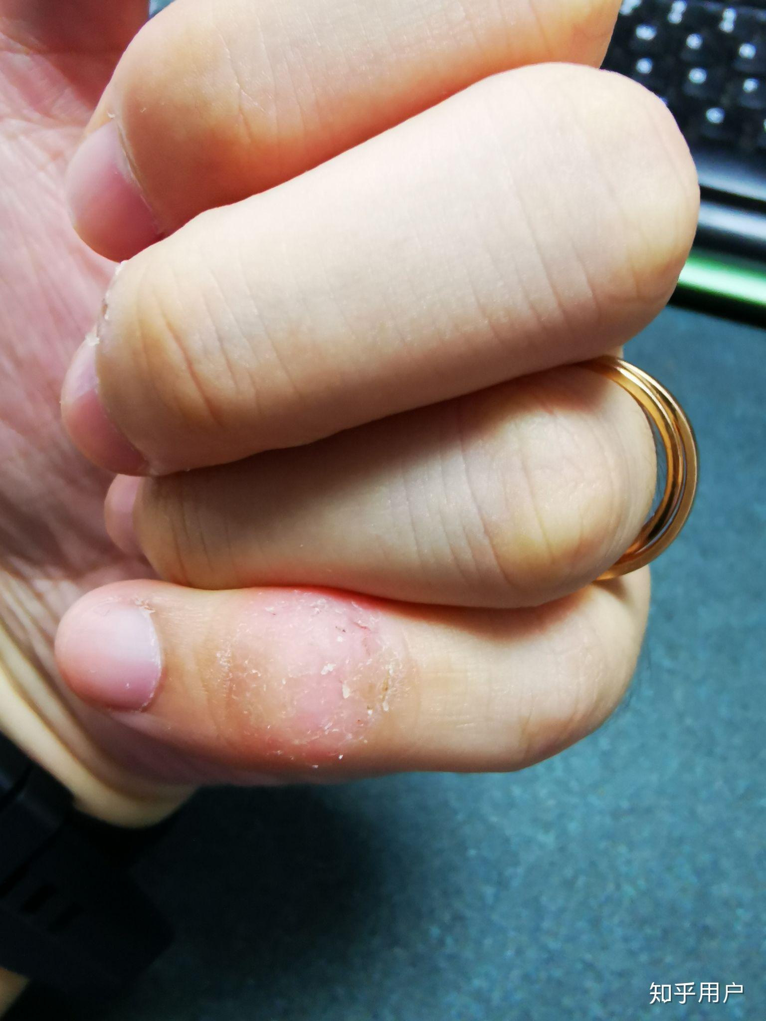 咬手皮是一种怎样的心理?