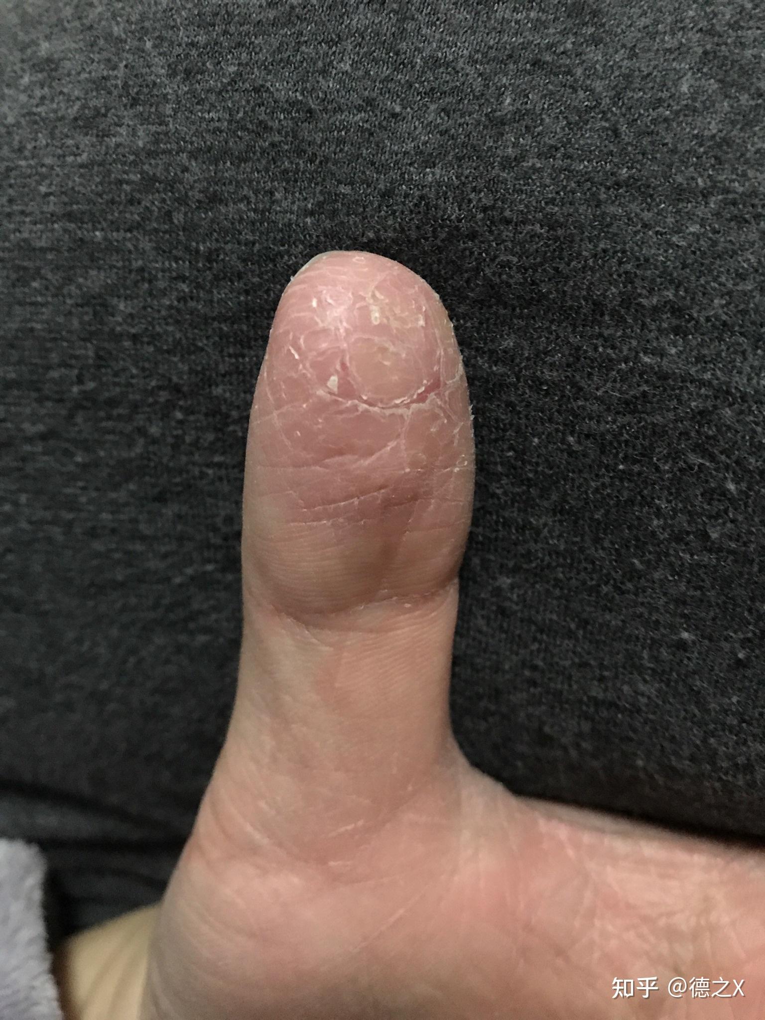 手指开裂周围皮肤干硬是怎么回事