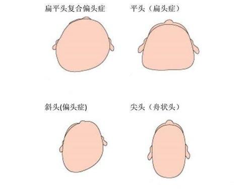 扁头做整形手术真的能变成圆头吗?骨水泥填充手术的风险大不 - 知乎