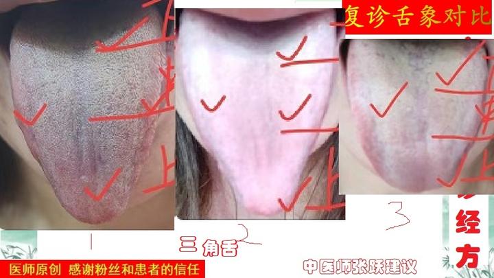 肝郁舌 三角舌 柴胡舌 中医师张跃舌诊 - 知乎