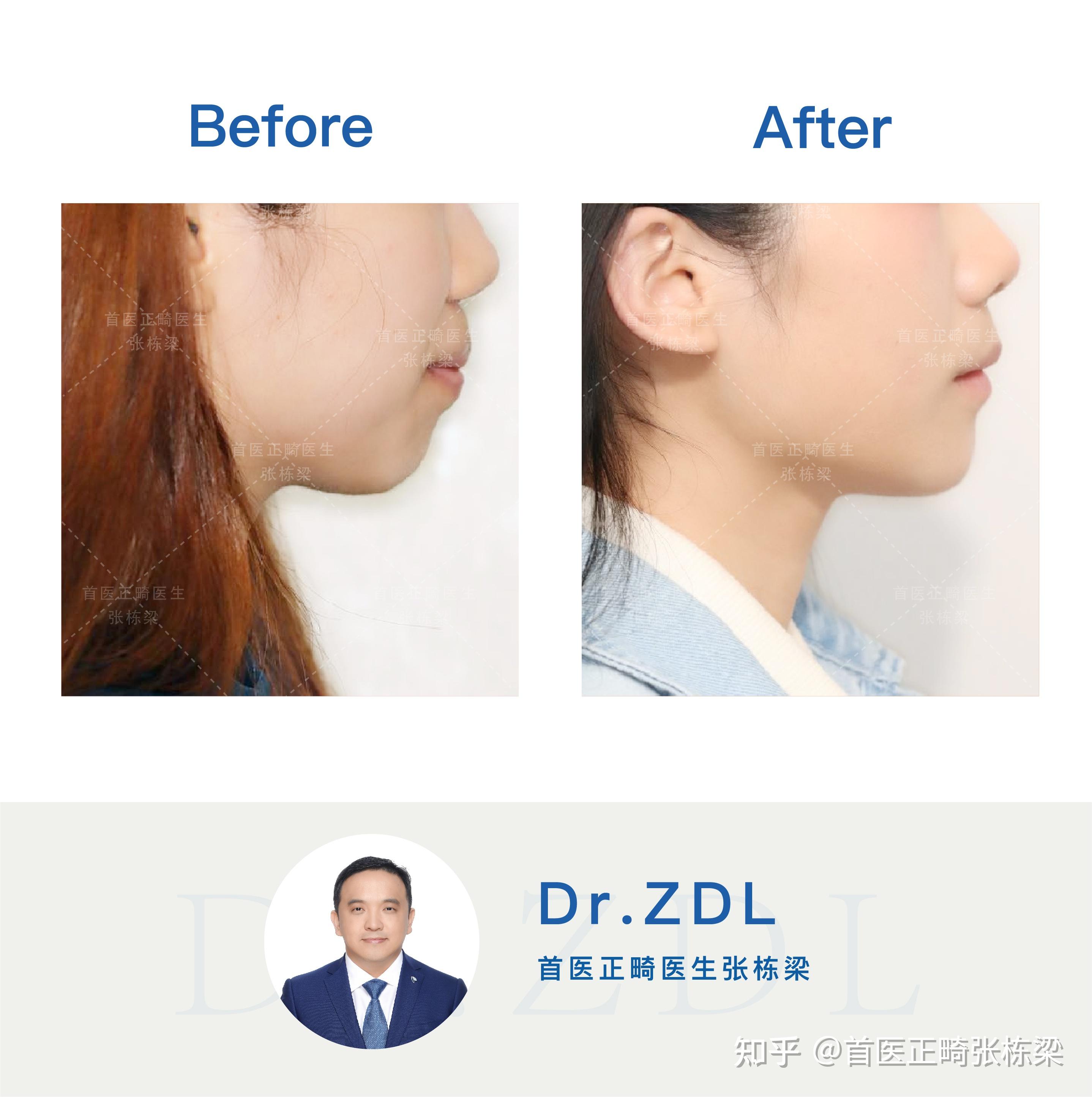 上颌骨略突 下颌后缩(或者也是突出?)可以通过牙齿正畸改善吗?