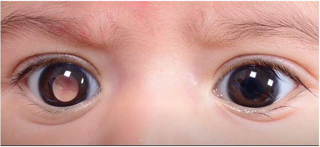 小孩眼底黄斑病变图片图片